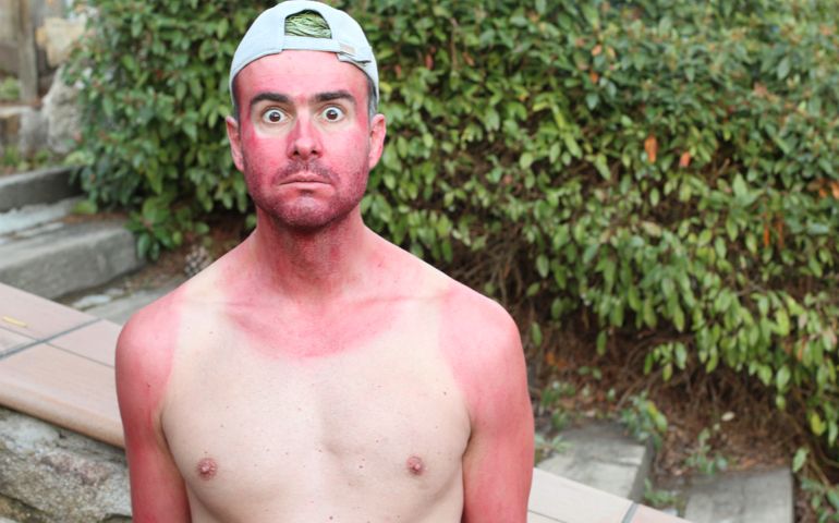 Sunburned young man with extreme tan lines.
