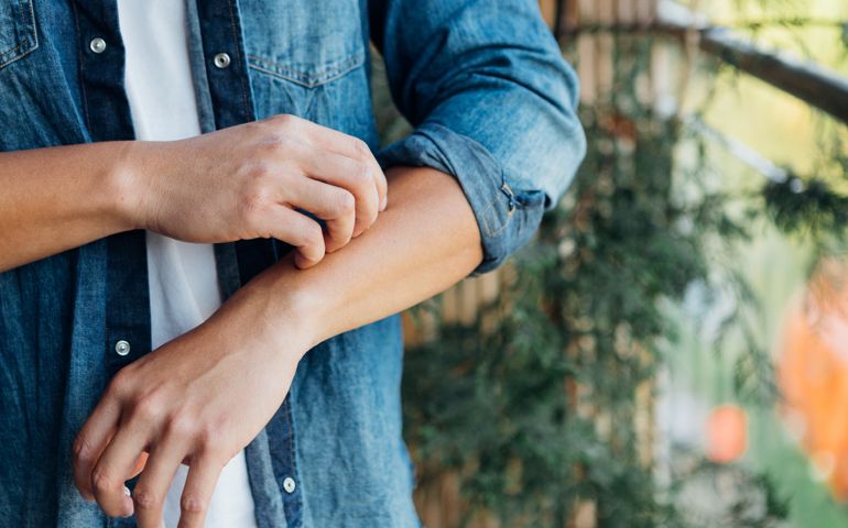 Cropped shot of young man having allergy symptoms, scratching forearm with fingers.