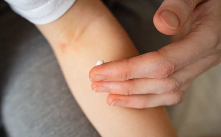 applying cream to dry patch