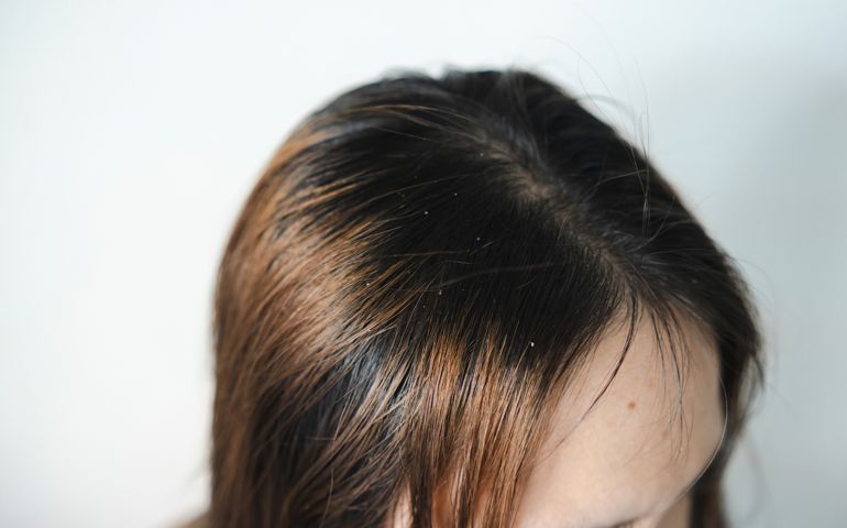 Dandruff on the scalp of Asian women