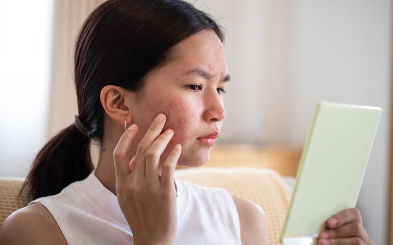 Conceptual shot of Acne &amp; Problem Skin on female face.